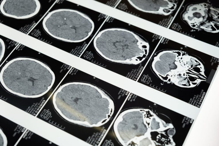 A Link Between Aluminum and Autism? What This Brain Study Reveals